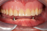 Dental_ImplantXS_purch